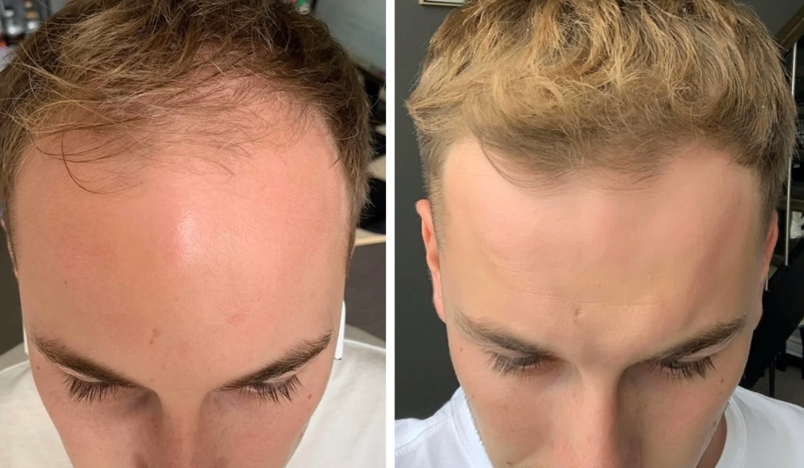 Kirkland Minoxidil