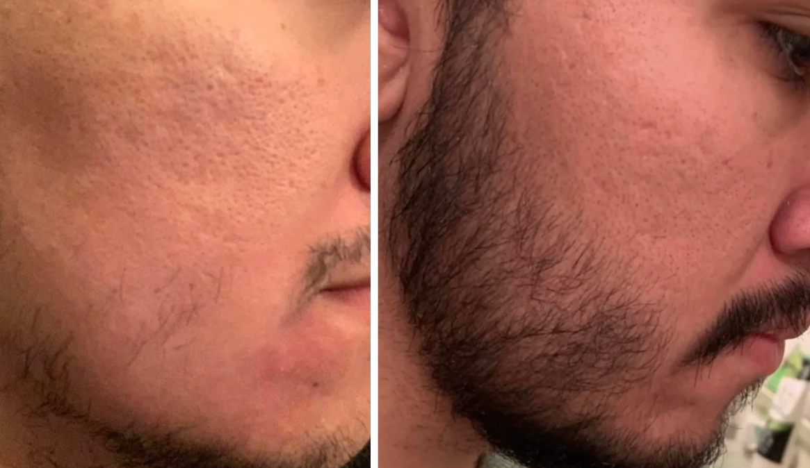 Kirkland Minoxidil
