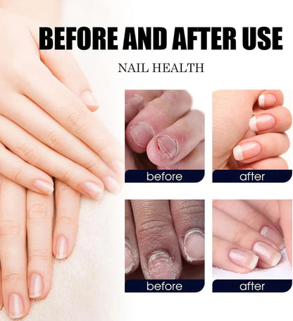 Ginger Nail Treatment Nail Support Nail Care