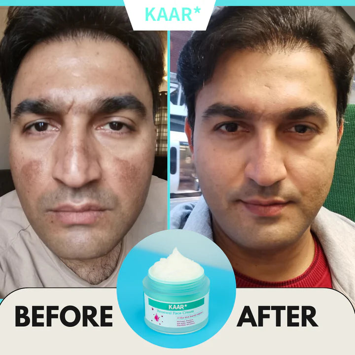 Renewing Cream | Fade Stubborn Spots in 14 Days